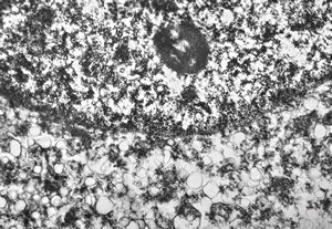 F,50y. | papilomavirus in glial cell - progressive multifocal leukodystrophy F,50y. | papilomavirus in glial cell - progressive multifocal leukodystrophy